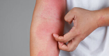 skin-rash