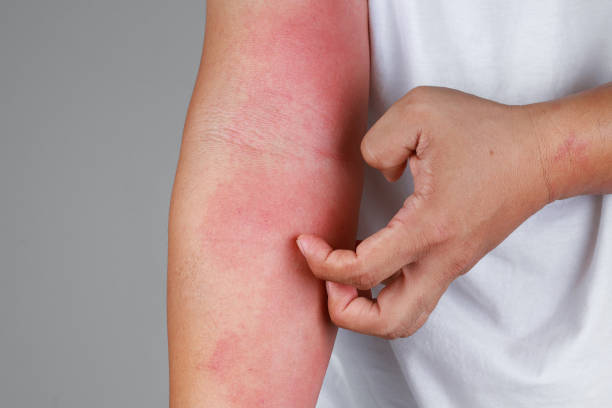 skin-rash