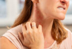allergic-probiotics