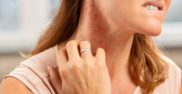 allergic-probiotics